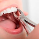 Foto de Extracciones Dentales