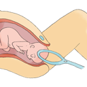 Foto de Parto distócico