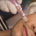 Foto de Dermapen Plus