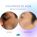 Foto de Cicatrices de acné - 6 tratamientos