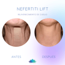 Foto de Nefertiti Lift - Rejuvenecimiento de Cuello